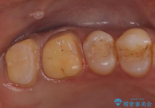 【オールセラミック】歯がズキズキ痛い。の治療中