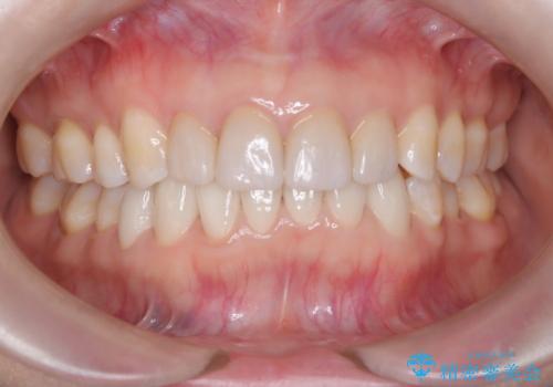 【オールセラミック】下の前歯が痛い。の治療後