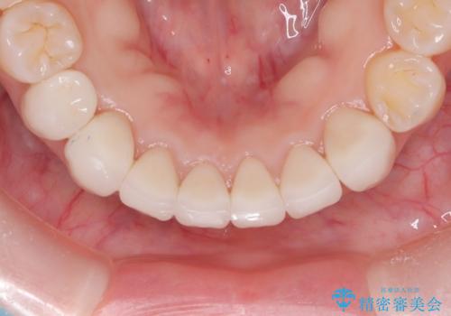 【オールセラミック】下の前歯が痛い。の治療後