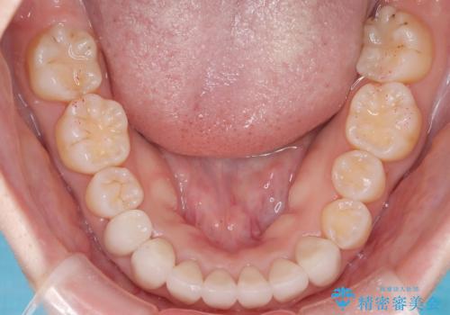 【オールセラミック】下の前歯が痛い。の治療後