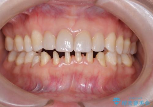 【オールセラミック】下の前歯が痛い。の治療中