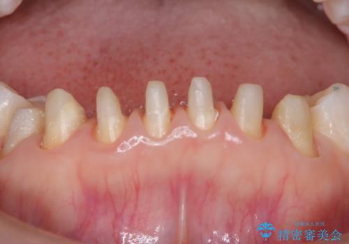 【オールセラミック】下の前歯が痛い。の治療中