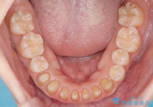 【オールセラミック】下の前歯が痛い。の治療中