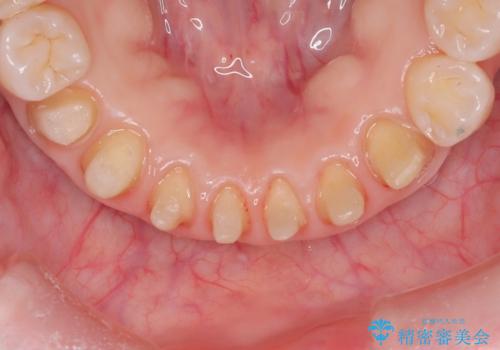 【オールセラミック】下の前歯が痛い。の治療中