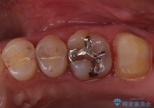 【精密根管治療】奥歯がズキズキ痛い。の治療中