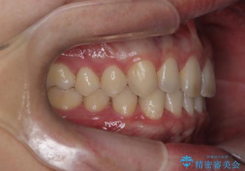 【インビザライン】前歯の隙間を治したい。の治療後