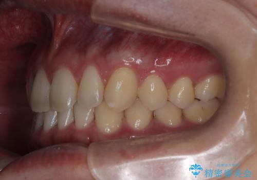 【インビザライン】前歯の隙間を治したい。の治療後