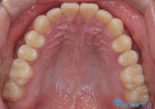 【インビザライン】前歯の隙間を治したい。の治療後