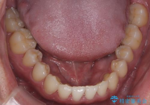 【インビザライン】前歯の隙間を治したい。の治療後