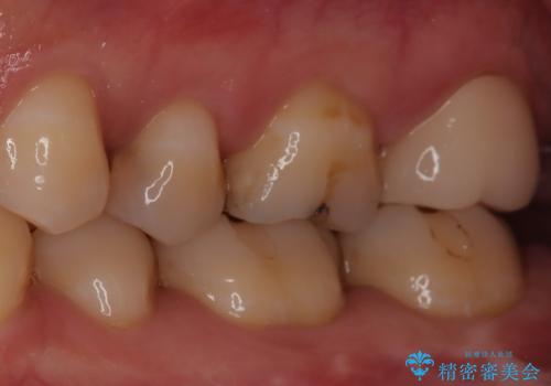 【精密根管治療】奥歯がズキズキ痛い。の治療後