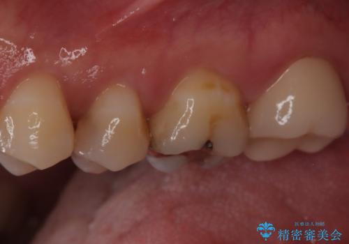 【精密根管治療】奥歯がズキズキ痛い。の治療後