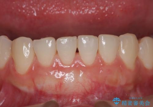 【歯肉退縮】歯茎の移植を行なった症例。