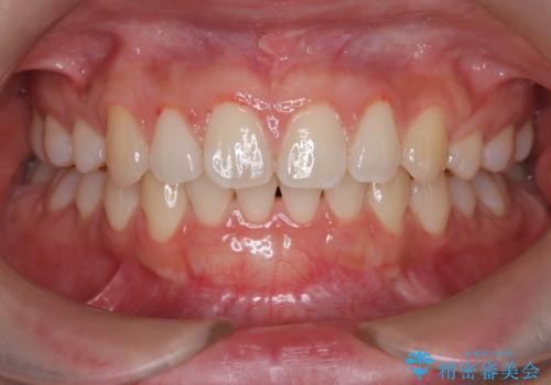 【歯肉退縮】歯茎の移植を行なった症例。の治療後