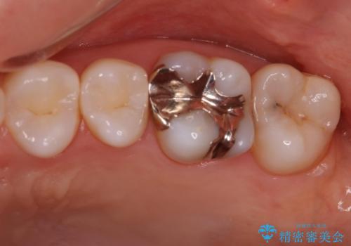 メタルフリーにしたい。の治療前