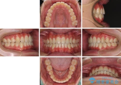 受け口傾向の咬み合わせ インビザラインできれいな口元にの治療後