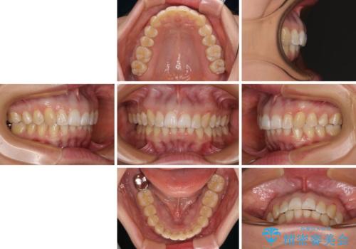 カリエール・ディスタライザーとインビザラインを用いた前歯の咬み合わせ改善の治療後