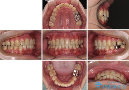 重なって磨きにくい上下の前歯 ワイヤー装置での抜歯矯正の治療後