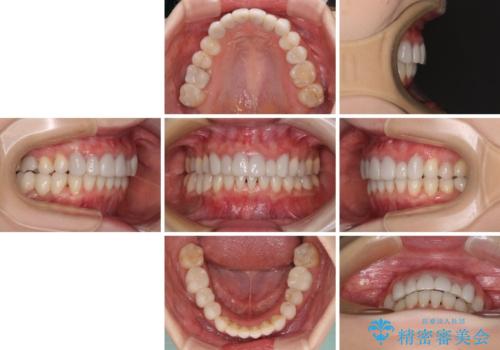 前歯のデコボコと奥歯の咬み合わせをインビザラインで改善の治療後