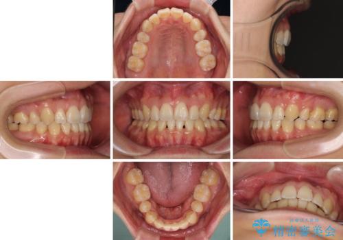 重なり合って磨きにくい前歯 ワイヤー装置での抜歯矯正の治療後