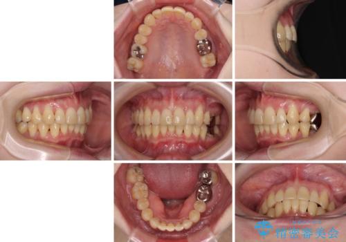 八重歯と先天欠損の歯列 ワイヤー矯正ですっきりとの治療後