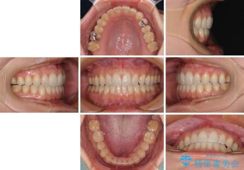 【モニター】狭い上顎歯列とオープンバイト 急速拡大装置を用いた矯正治療の治療後