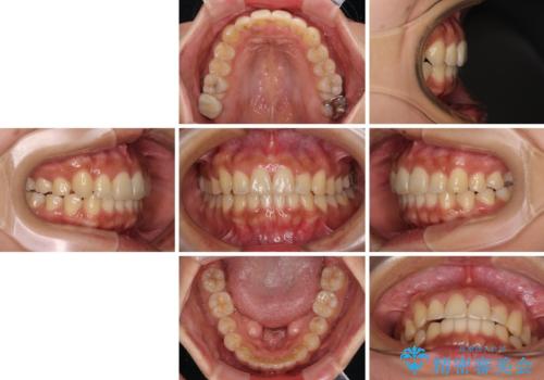 【モニター】歯列が狭くデコボコが気になる 急速拡大装置を用いたインビザライン矯正の治療後