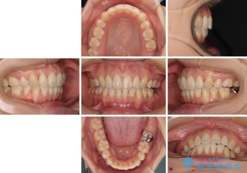 前歯のデコボコを抜歯矯正で改善 メタル装置で費用を抑えるの治療後