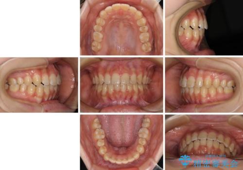 大学病院から転院 非抜歯で口元を下げるワイヤー矯正の治療後