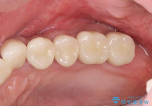 骨の造成を行った上顎インプラント治療の治療後