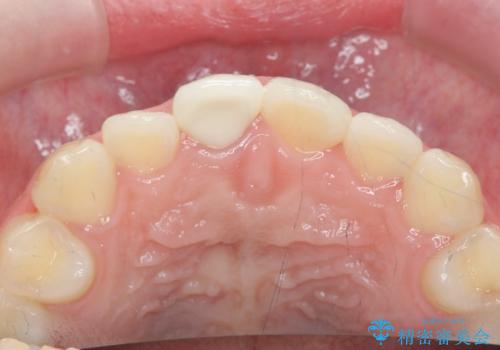 歯ぐきにできものができた 前歯の色調改善の治療後