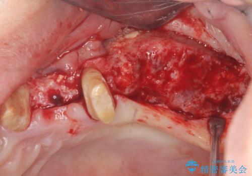 骨の造成を行った上顎インプラント治療の治療中
