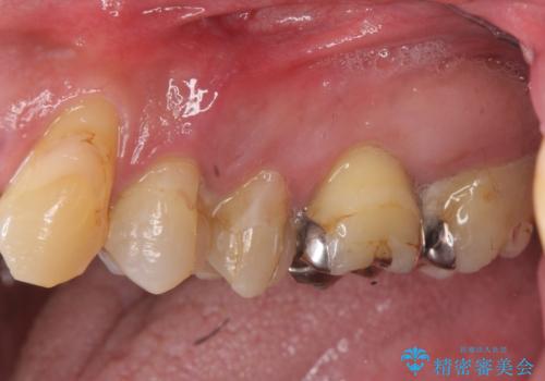 骨の造成を行った上顎インプラント治療の治療前