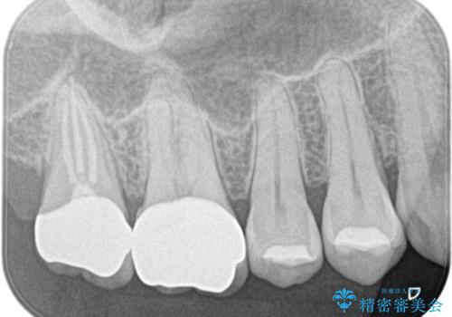 【オールセラミック】歯がズキズキ痛い。の治療後