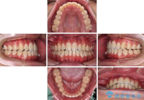 受け口傾向の咬み合わせ インビザラインできれいな口元にの治療中