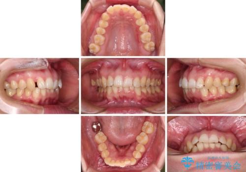 カリエール・ディスタライザーとインビザラインを用いた前歯の咬み合わせ改善の治療中