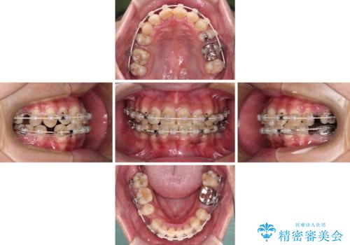 重なって磨きにくい上下の前歯 ワイヤー装置での抜歯矯正の治療中