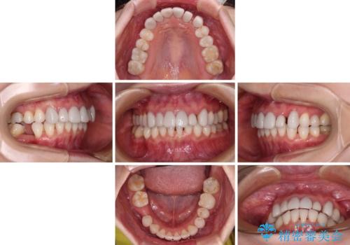 前歯のデコボコと奥歯の咬み合わせをインビザラインで改善の治療中