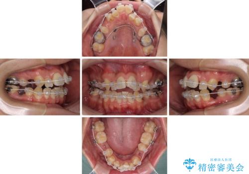 重なり合って磨きにくい前歯 ワイヤー装置での抜歯矯正の治療中