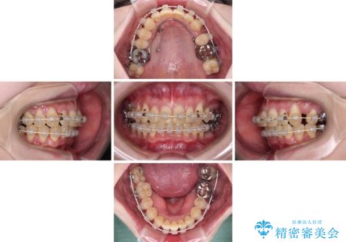 八重歯と先天欠損の歯列　ワイヤー矯正ですっきりとの治療中