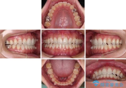 【モニター】狭い上顎歯列とオープンバイト 急速拡大装置を用いた矯正治療の治療中