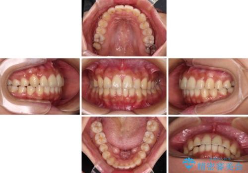 【モニター】歯列が狭くデコボコが気になる 急速拡大装置を用いたインビザライン矯正の治療中