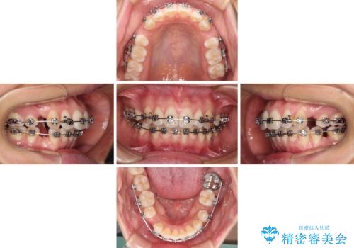前歯のデコボコを抜歯矯正で改善 メタル装置で費用を抑えるの治療中