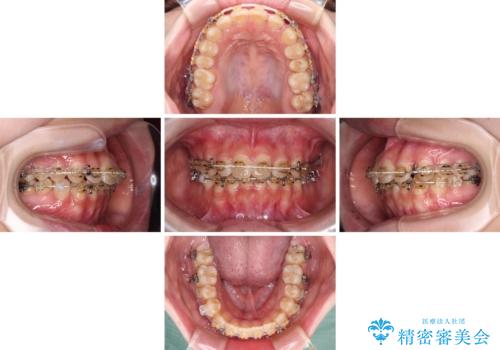 大学病院から転院 非抜歯で口元を下げるワイヤー矯正の治療中