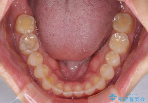 【モニター】狭い上顎歯列とオープンバイト 急速拡大装置を用いた矯正治療の治療前