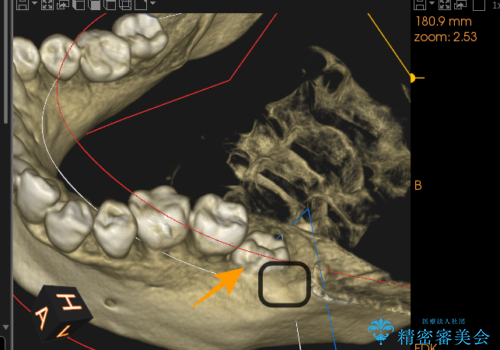 【埋伏智歯と埋伏智歯の過剰歯の抜歯】埋まっている親知らず2本の抜歯の治療前