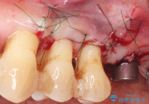 強い咬合力に対抗する歯周補綴の治療前