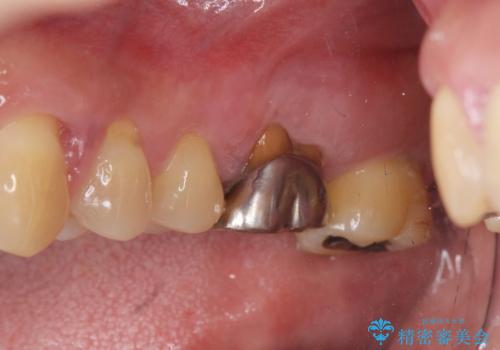 強い咬合力に対抗する歯周補綴の症例 治療前