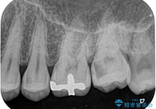 【精密根管治療】奥歯がズキズキ痛い。の治療前