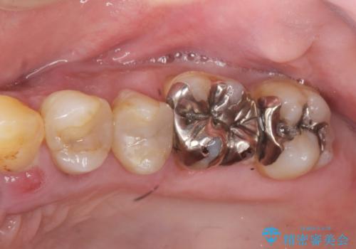 骨の造成を行った上顎インプラント治療の治療前