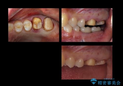 歯科でトラウマ 怖くて行っていなかったが、今度こそきちんと治療したいの治療中